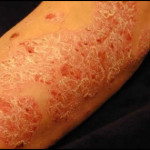 psoriasis