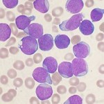 Leucemia