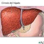 cirrosis01