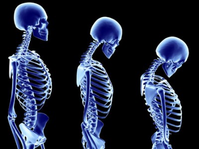 Nuevos fármacos para la osteoporosis superan a los actuales