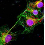 biomarcador_alzheimer
