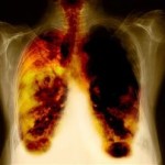 Cancer-de-pulmon