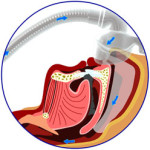 cpap_treatment