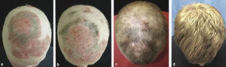 patient-baldness-before-and-after-treatment