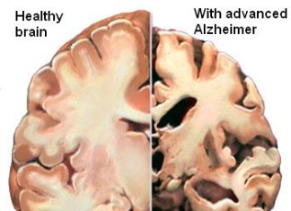 Análisis del líquido cefalorraquídeo puede detectar Alzheimer temprano