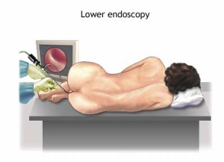 Encontrado posible relación entre la bacteria, el cáncer de colon