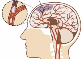 Accidente Cerebrovascular