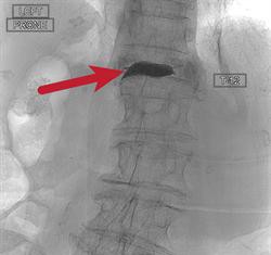 A los 99 años, una mujer recupera movilidad de la columna vertebral