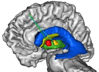 Investigadores logran paso importante en el tratamiento de la enfermedad de Huntington