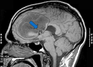 AMG 595, droga para el glioma maligno en ensayo experimental con humanos