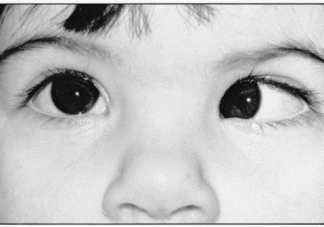 Estrabismo: una cirugía simple para una condición compleja