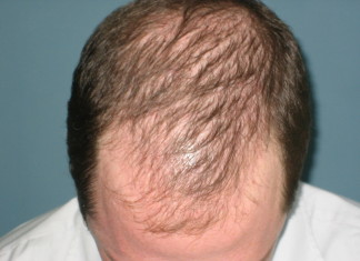 Investigación identifica inhibidor de la causa de la calvicie y el objetivo de los tratamientos de pérdida de pelo