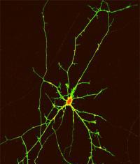Las células madre apuntan a un posible tratamiento para la enfermedad de Huntington