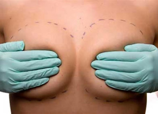 Brasil suspende temporalmente las importaciones de implantes mamarios