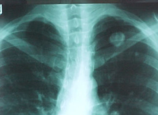 La autofagia: Cuando la «auto-alimentación» es buena. Fibrosis Quística