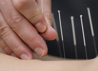 La acupuntura relacionada con una mejoría en pacientes con enfermedad pulmonar obstructiva crónica