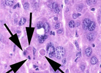 Marcado para la destrucción: Nuevo desarrollo desencadena la muerte de las células cancerosas