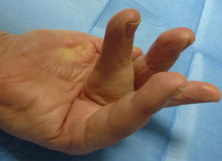 Tratamiento ambulatorio para la enfermedad de Dupuytren