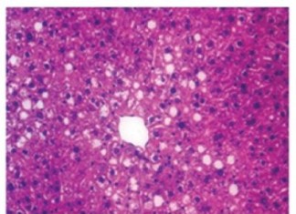 La grasa en el hígado recibe una llamada de atención que mantiene los niveles de azúcar en la sangre Higado Graso