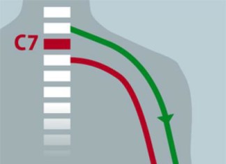 Cirujanos consiguen restaurar la función de la mano en un paciente tetrapléjico