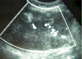 Recomendadas pruebas BRCA1/2 para detectar el cáncer de ovario