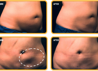 Procedimiento que «congela» células de grasa ayuda a tonificar el cuerpo