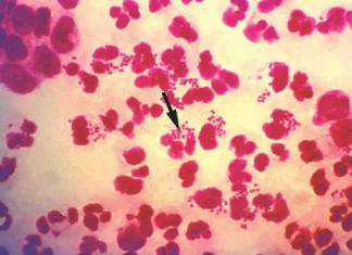 La gonorrea cada vez más resistentes a los medicamentos, la OMS advierte