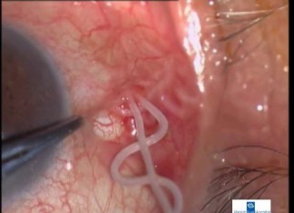 India : Medico retira un gusano vivo con 13 cm del ojo de un paciente