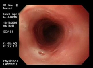Nuevo método quirúrgico alivia los síntomas del ardor de estómago