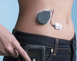 Más avances en el páncreas artificial para los pacientes con diabetes