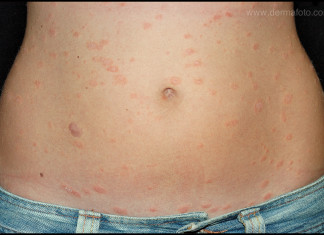 La proteína puede ser la clave de la psoriasis
