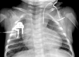 Aumentan los casos de enfermedad tromboembólica venosa en hospitalizaciones