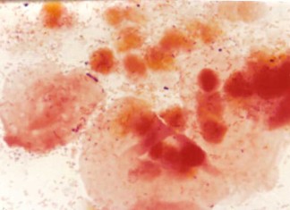 La vaginosis bacteriana se asocia con mayor riesgo de transmisión del VIH