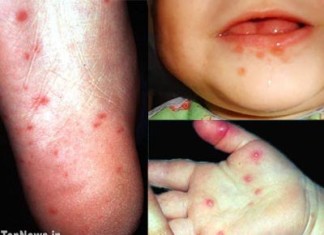 52 muertes en Camboya relacionadas a una enfermedad infantil común