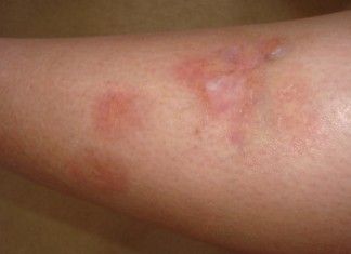 Necrobiosis lipoidica: actualización sobre su etiopatogenia y tratamiento