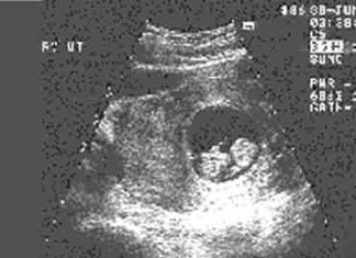 ¿Por qué fumar es «malo» para la trompa de Falopio? y aumenta el riesgo de embarazo ectópico