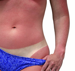 ¿Qué sucede cuando en las quemaduras solares? Los investigadores describen mecanismo inflamatorio por primera vez