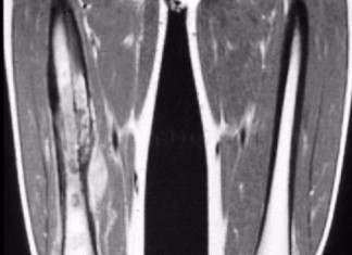 Nueva marca y nuevo objetivo en el sarcoma de Ewing