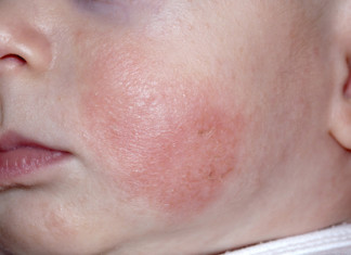 Tratamiento tópico muestra potencial para el eczema infantil