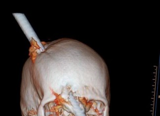 Trabajador brasileño sobrevive a perforación con un barra de hierro en el cráneo