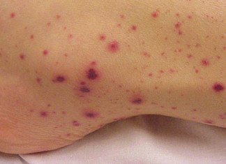 La sepsis en recién nacidos