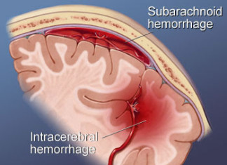 Dejar de fumar reduce el riesgo elevado de hemorragia subaracnoidea