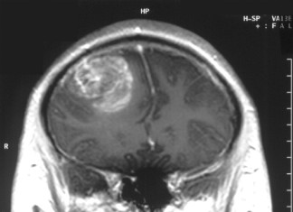 Farmacos y radioterapia pueden llevar a un tratamiento para el tumor cerebral