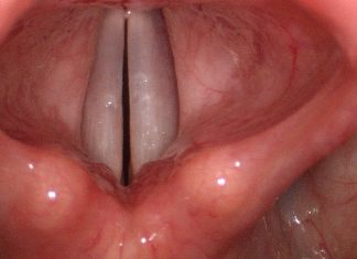 cuerdas vocales inflamadas