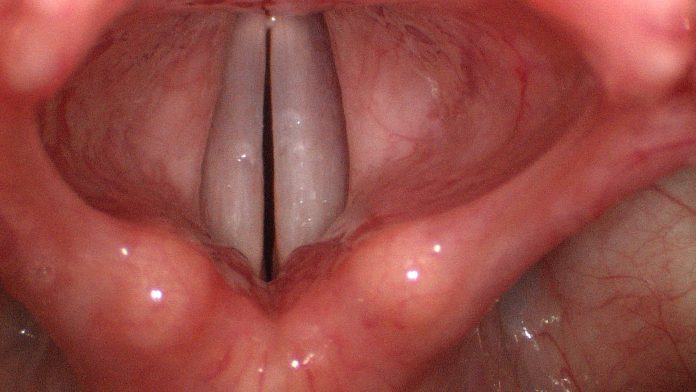 cuerdas vocales inflamadas