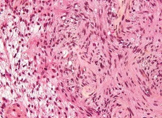 Nuevo fármaco para el cáncer hereditario