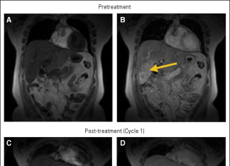 Estudio internacional demuestra eficacia de un nuevo medicamento para el cáncer gástrico