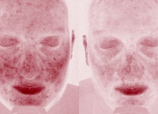 Mirvaso® (brimonidina), el primer y único tratamiento dirigido el enrojecimiento facial de la rosácea, aprobado por la Comisión Europea