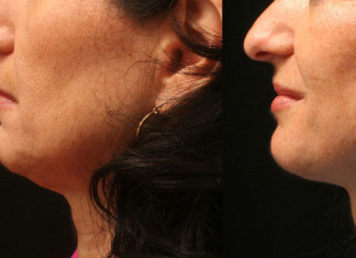 Liposucción de cuello