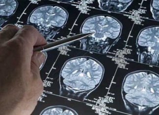 Alzheimer: ¿Podría estar implicada una barrera hematoencefálica con fugas?